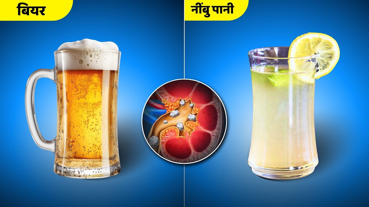 किडनी स्टोन के लिए बीयर या नींबू पानी: क्या है वैज्ञानिक सच?